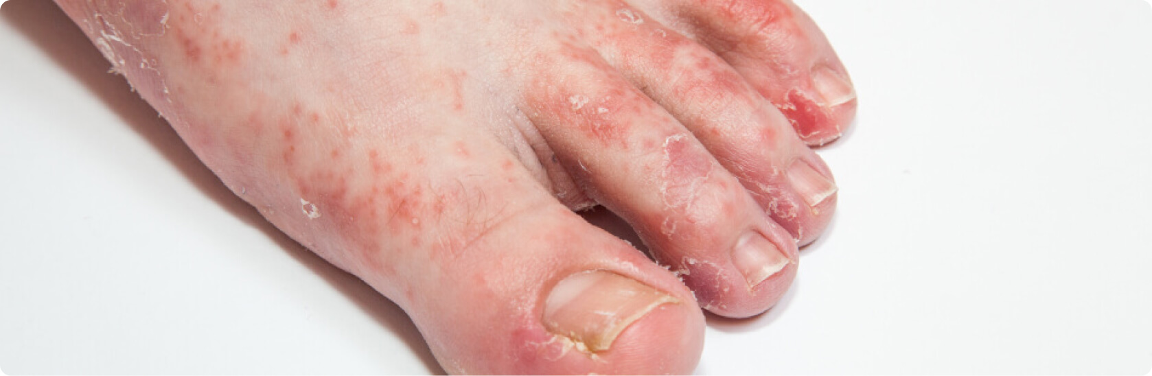 Fußpilz - Welche Risikofaktoren begünstigen eine Tinea pedis?