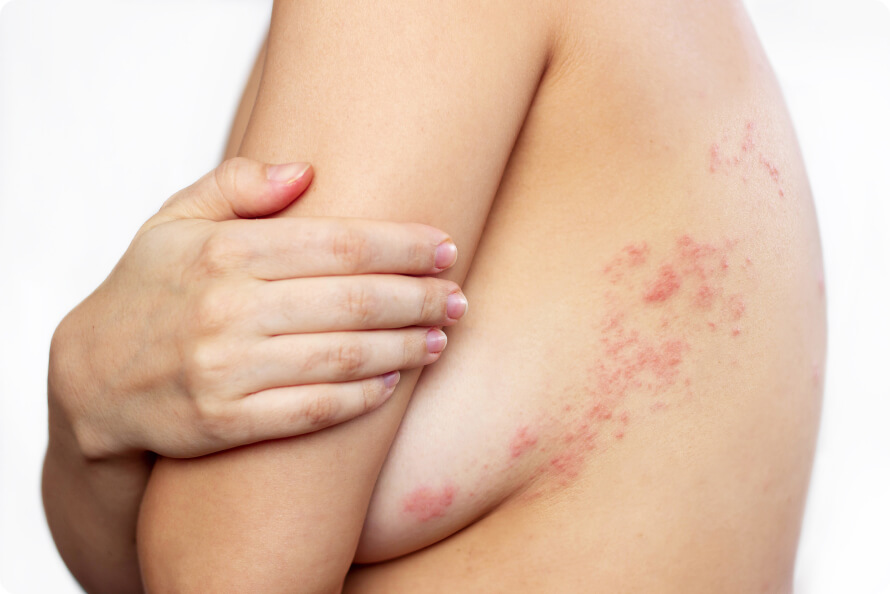 Gürtelrose (Herpes Zoster) - Welche Körperregionen sind von Herpes Zoster betroffen?