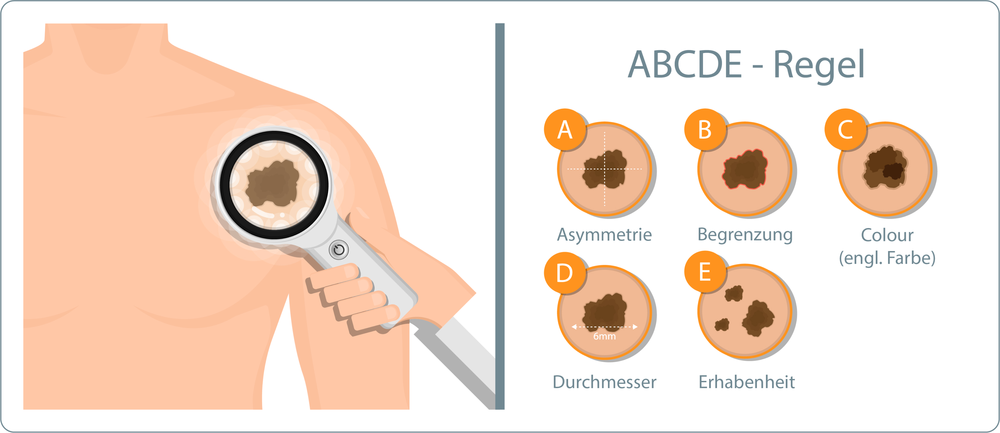 Hautkrebs - ABCDE-Regel
