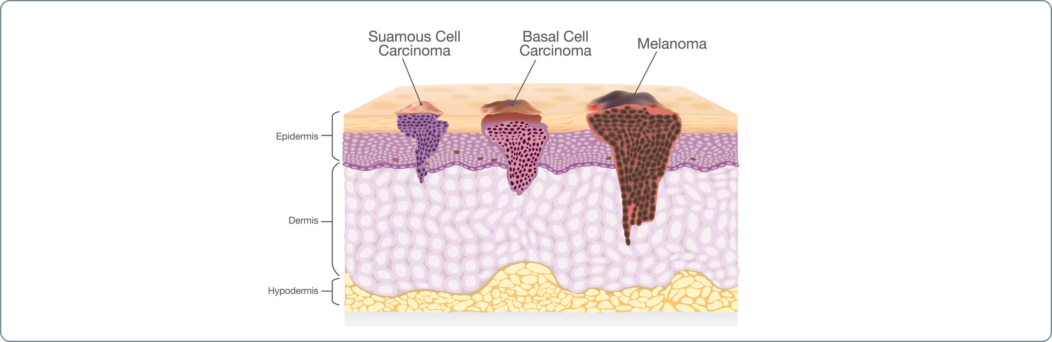 Hautkrebs - Wie ist der Krankheitsverlauf bei Hautkrebs?