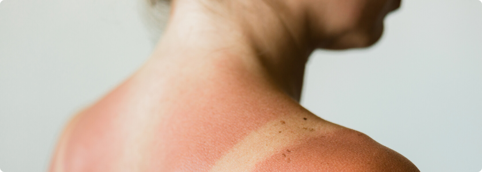 Hautkrebs - Sonnenbrand