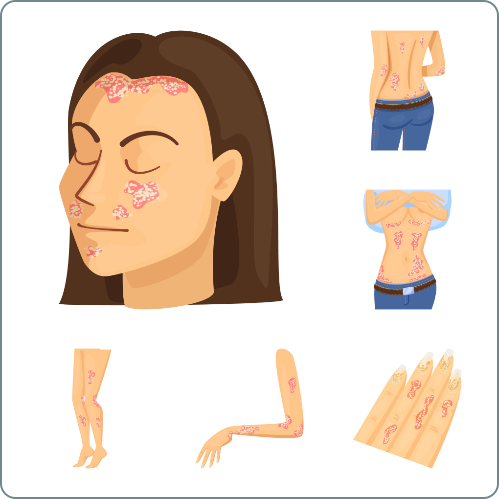 Schuppenflechte (Psoriasis) - Kopfhaut, die Arme, die Hände, die Beine, die Füße sowie die Fußsohlen