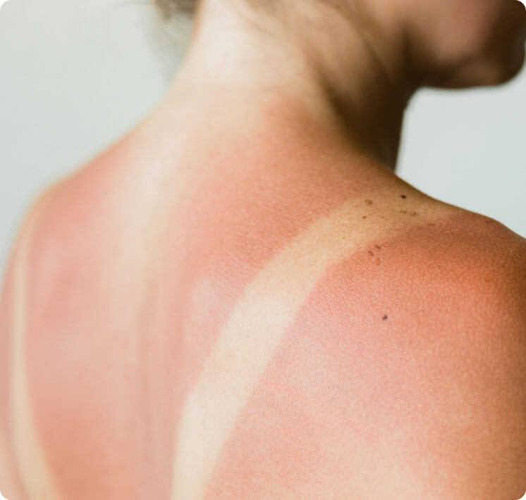Sonnenbrand - Wie lässt sich ein Sonnenbrand behandeln?