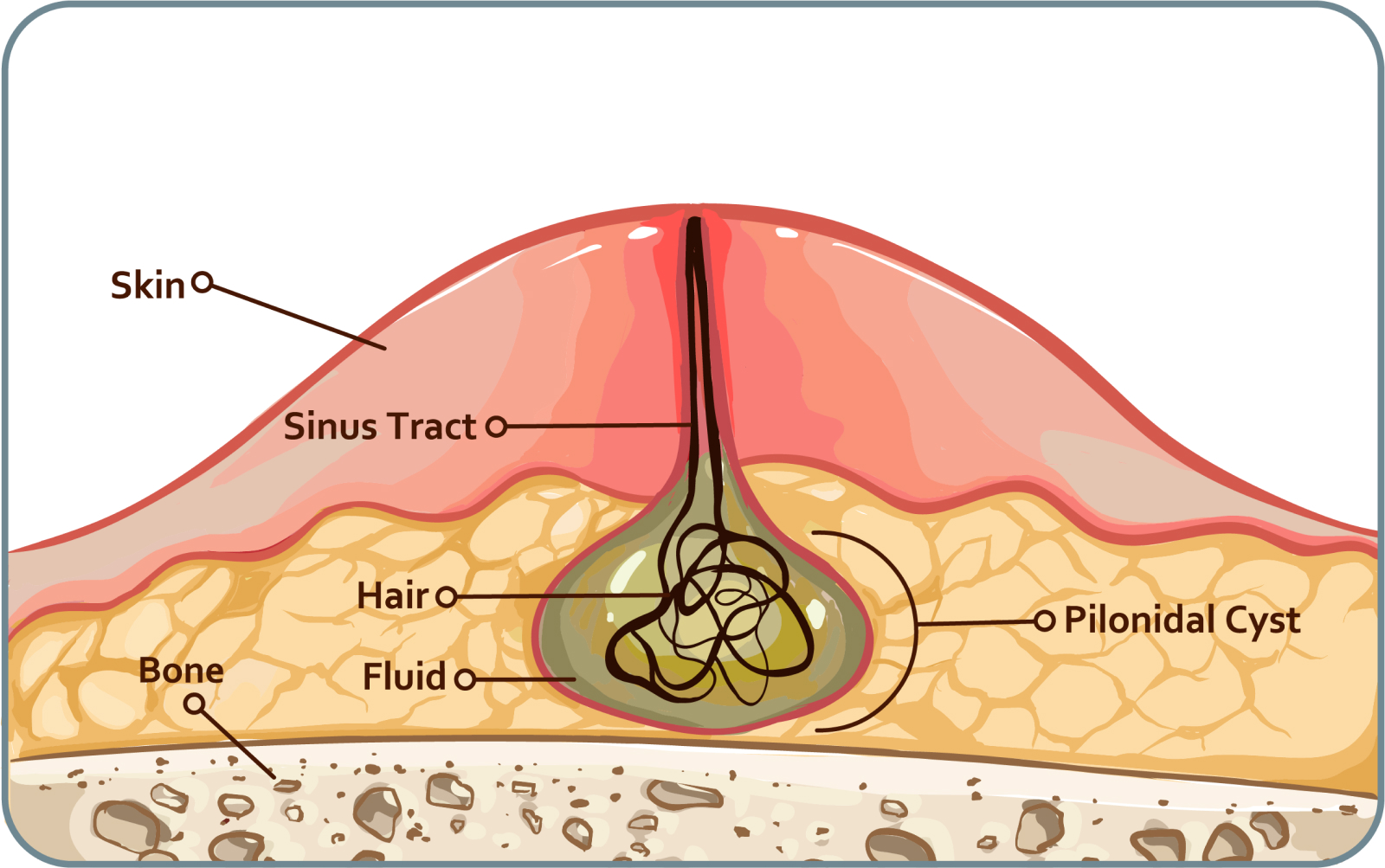 Steißbeinfistel (Sinus pilonidalis) - Häufigster Grund für die Entstehung einer Steißbeinfistel ist ein gestörtes Haarwachstum
