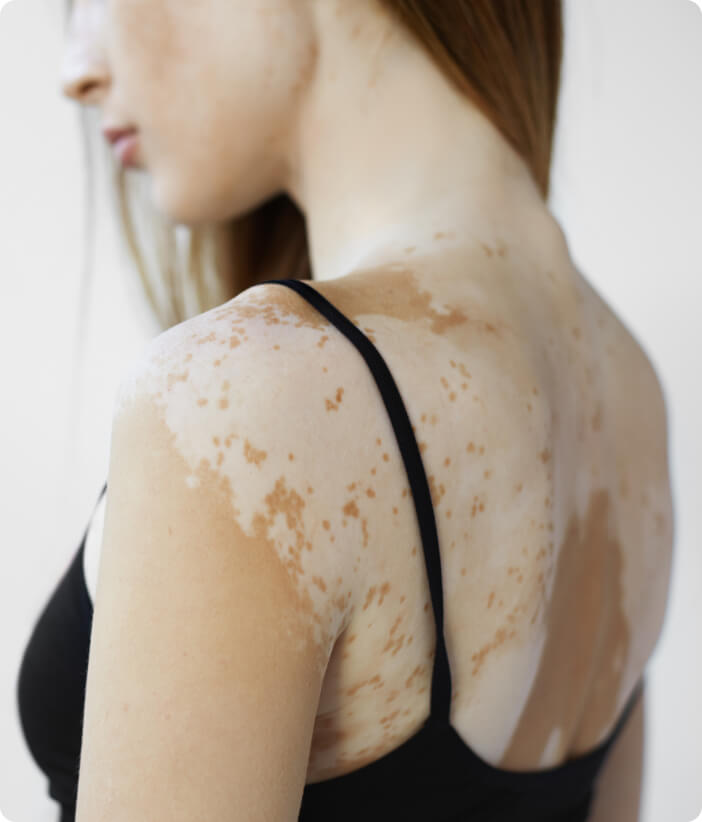 Vitiligo (Weißfleckenkrankheit) - Mit welchen Erkrankungen steht die Weißfleckenkrankheit in Verbindung?