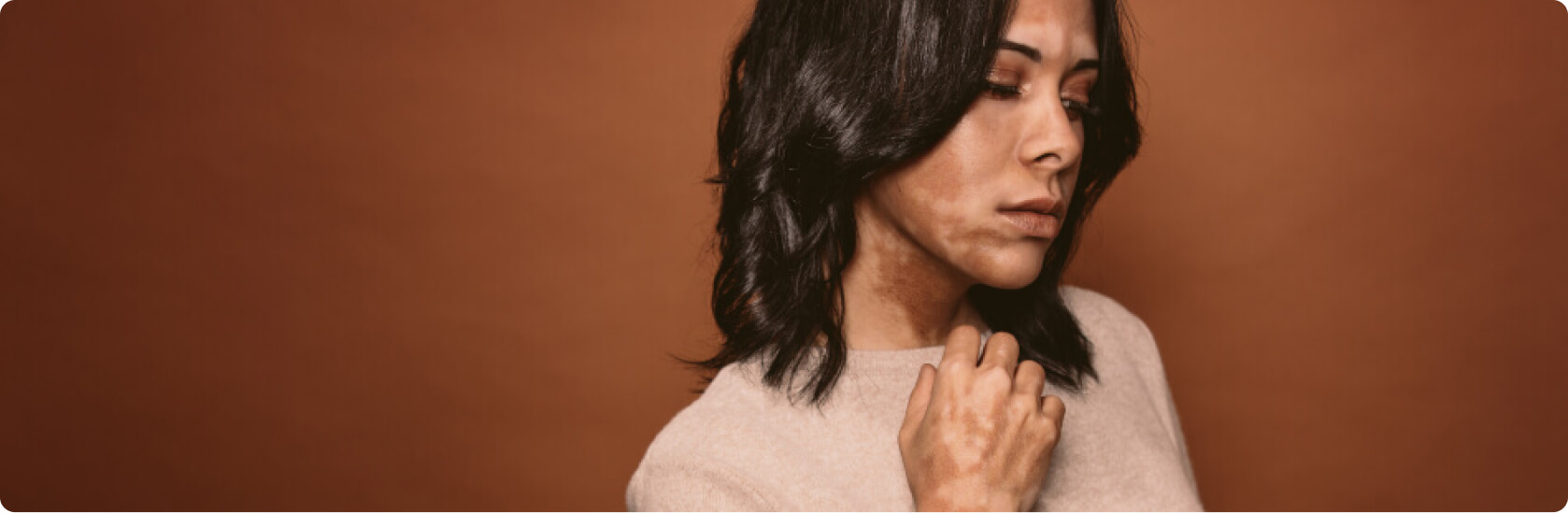 Vitiligo (Weißfleckenkrankheit) - Was versteht die Medizin unter Vitiligo?
