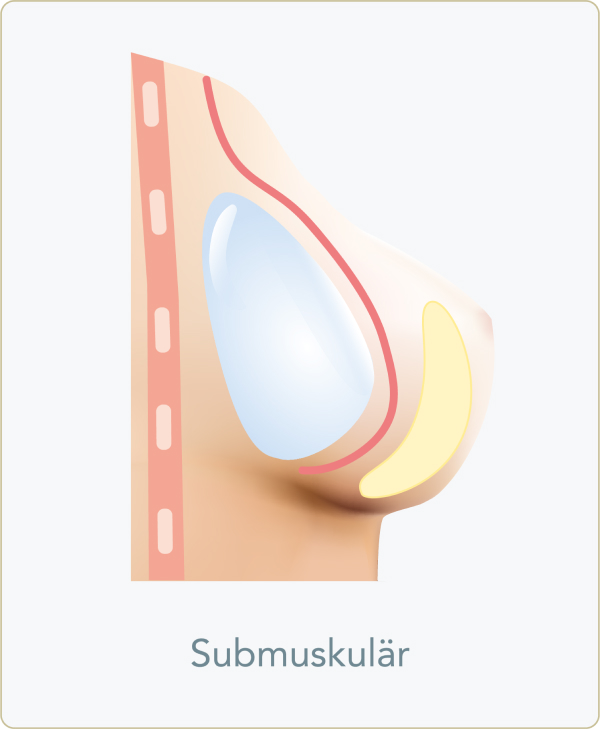 Subglanduläre Implantation - Submuskulär