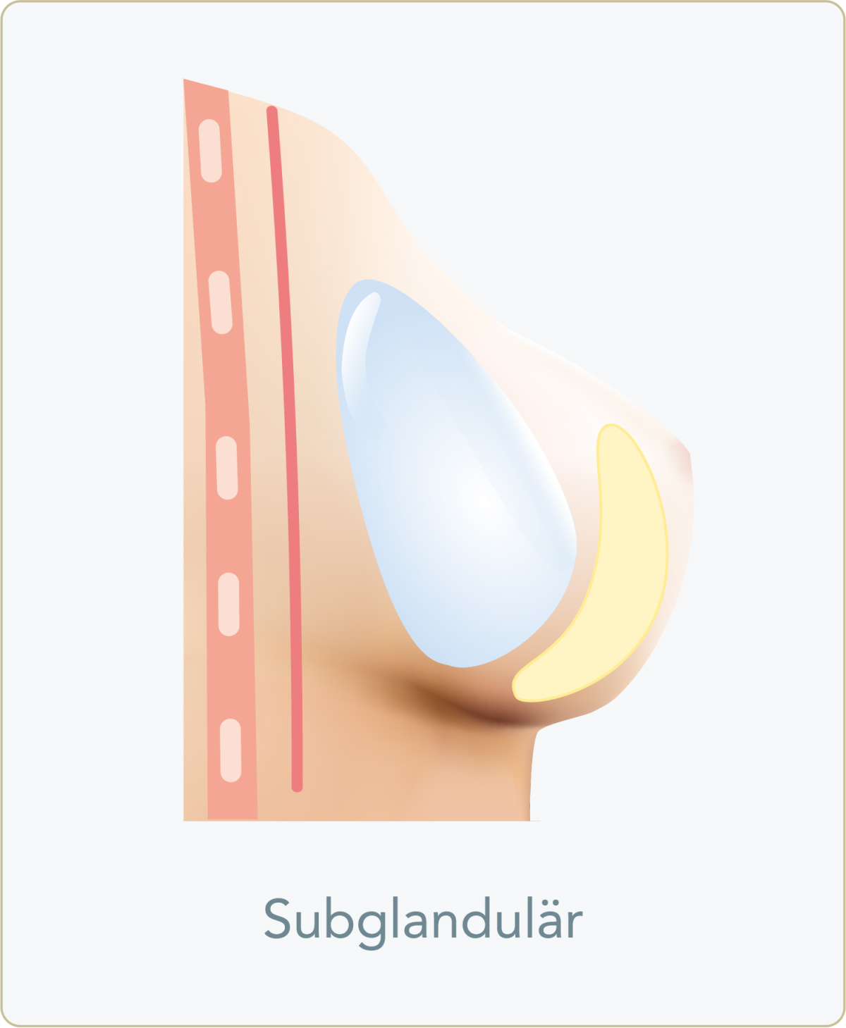 Submuskuläre (subpektorale) Implantation - Subglanduläre