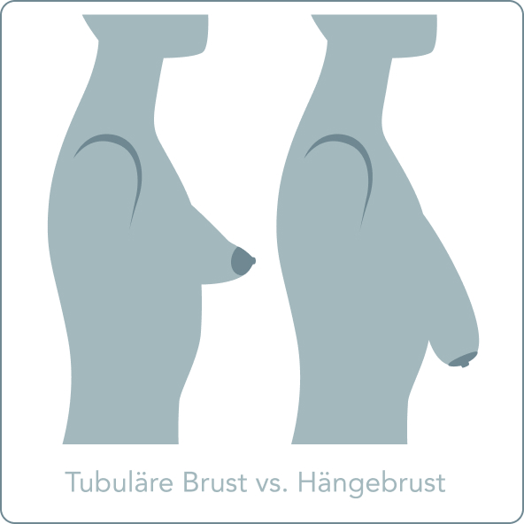 Tubuläre Brust - Was ist der Unterschied zwischen einer Schlauchbrust und einer Hängebrust?