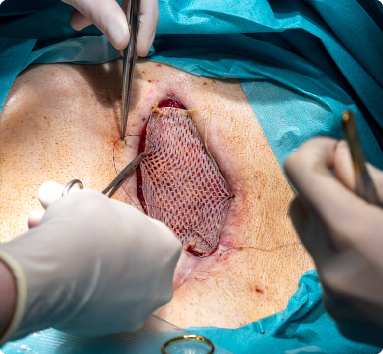 Hauttransplantation - Wie läuft eine Hauttransplantation ab?