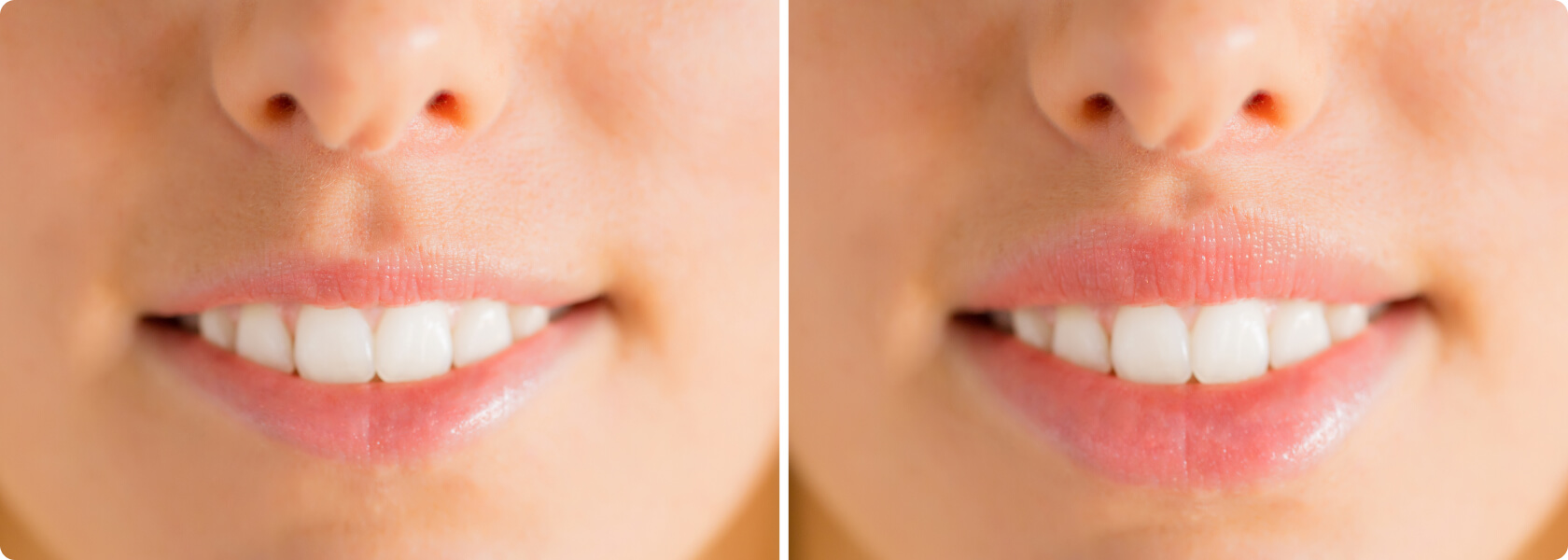 Botulinumtoxin (Botox©) - Lassen sich mit Botox© die Lippen vergrößern?