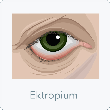 Augenlidstraffung - Was ist unter einem Ektropium zu verstehen?