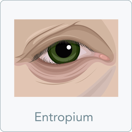 Augenlidstraffung - Wie macht sich ein Entropium bemerkbar?