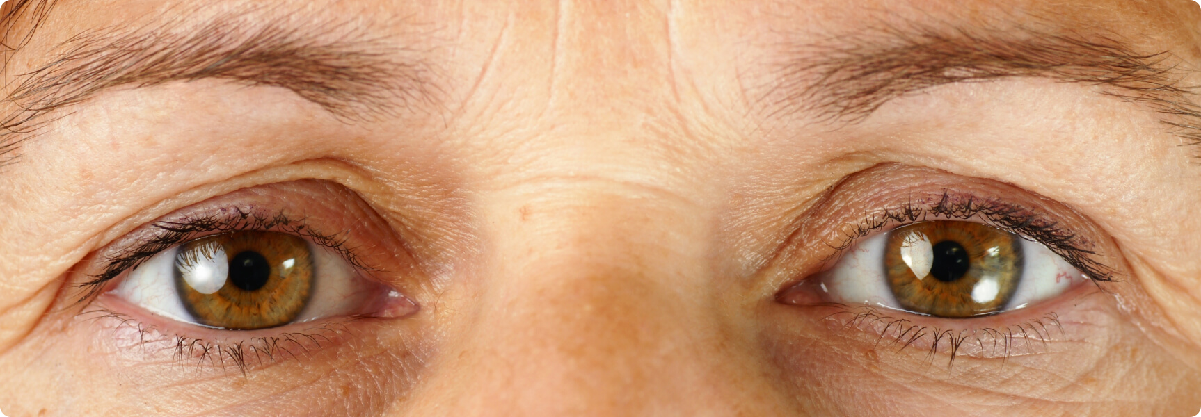 Augenlidstraffung - Wann ist eine operative Lidkorrektur sinnvoll?