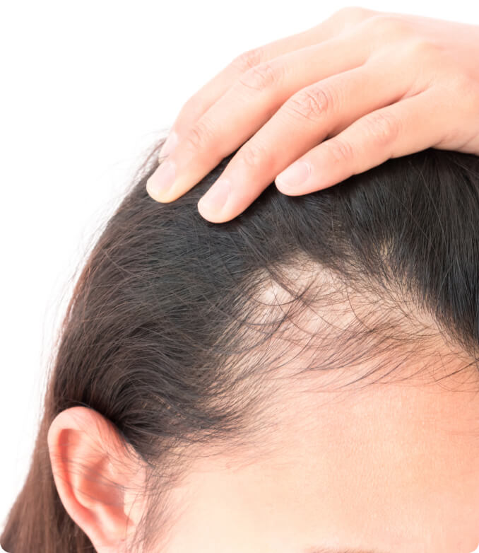 Haartransplantation - Aus welchen Gründen entscheiden sich Betroffene für eine Haartransplantation?