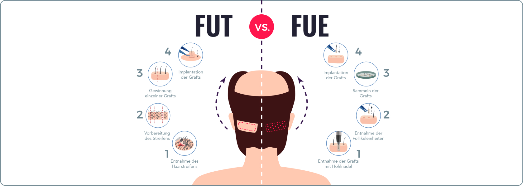 Haartransplantation - Was passiert bei einer Haartransplantation mit der FUE-Methode?