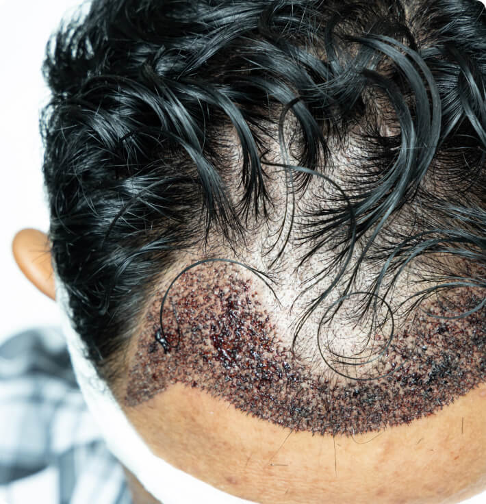 Haartransplantation - Wie gewinnt der Arzt die benötigten Haarwurzeln für die Haarverpflanzung?