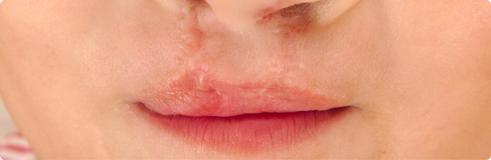 Lippen-Kiefer-Gaumenspalte (LKGS, Hasenscharte) - Wie lautet die medizinische Definition einer Lippen-Kiefer-Gaumenspalte?