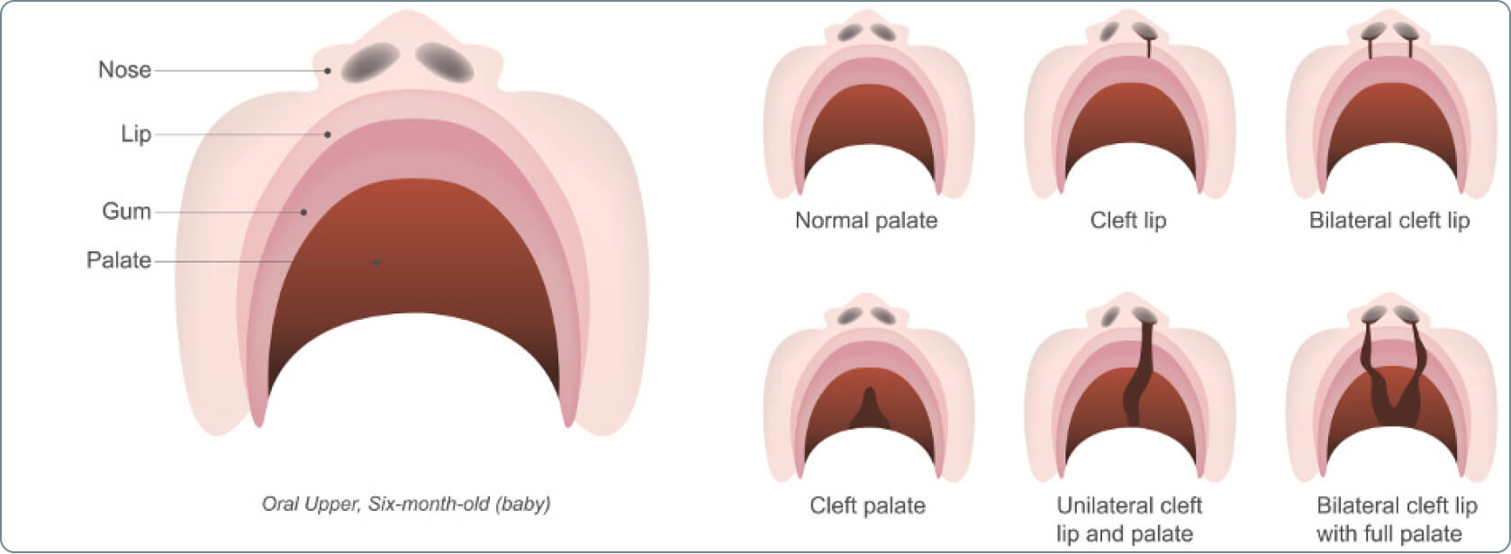 Lippen-Kiefer-Gaumenspalte (LKGS, Hasenscharte) - Was ist unter dem Begriff „uni- und bilateral“ im Zusammenhang mit der Lippen-Kiefer-Gaumenspalte zu verstehen?