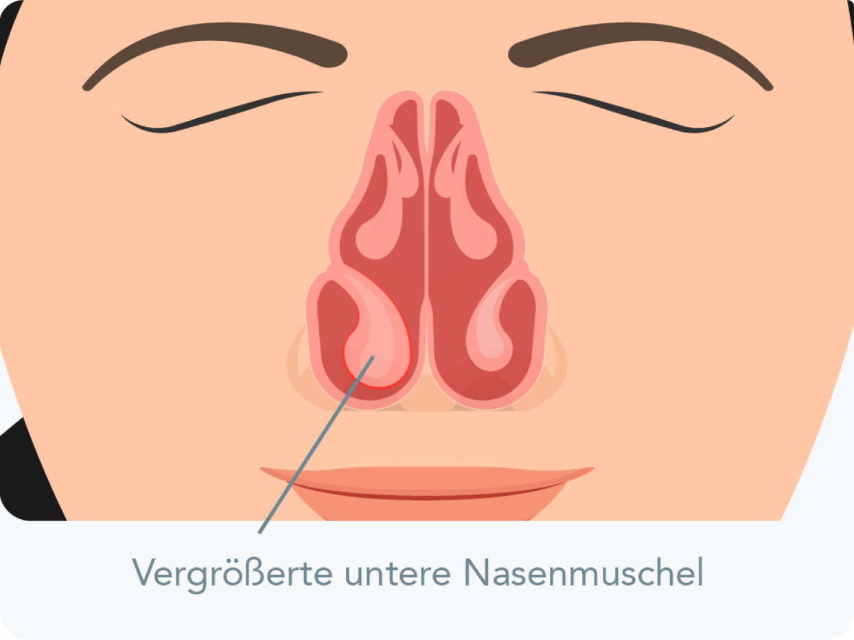 Nasenmuschelhyperplasie - die Nasenmuscheln stärker durchblutet werden und weiter anschwellen