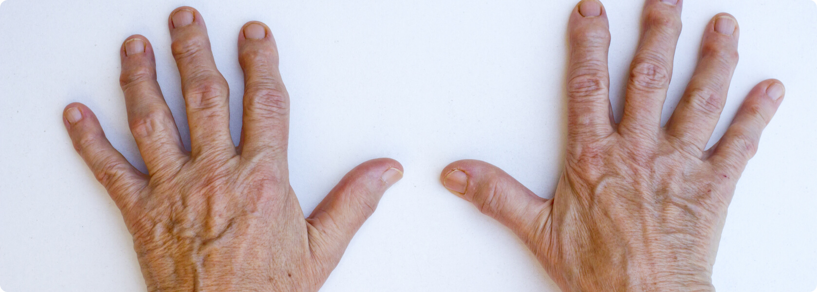 Arthritis - Was versteht die Medizin unter Arthritis?