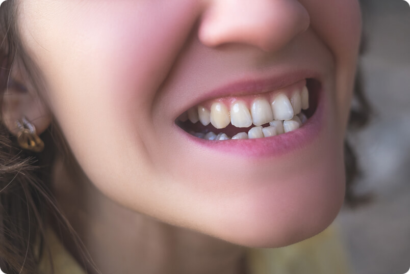 Kieferfehlstellung (Dysgnathie) - Wie unterscheidet sich eine Kieferfehlstellung von einer Zahnfehlstellung?