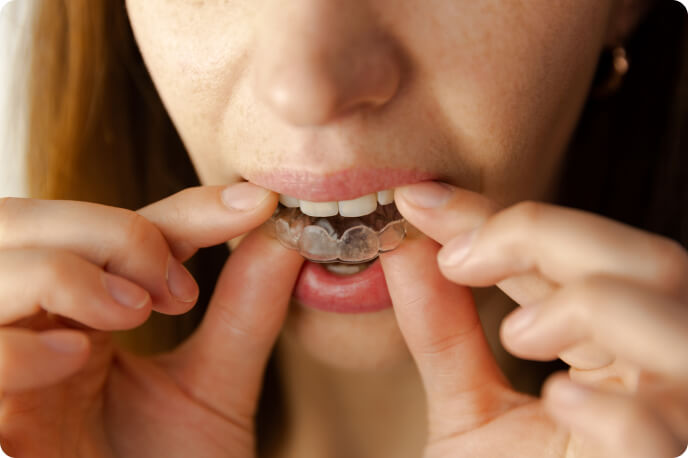 Schiefe Zähne - Kann eine Beißschiene die Zähne verschieben?