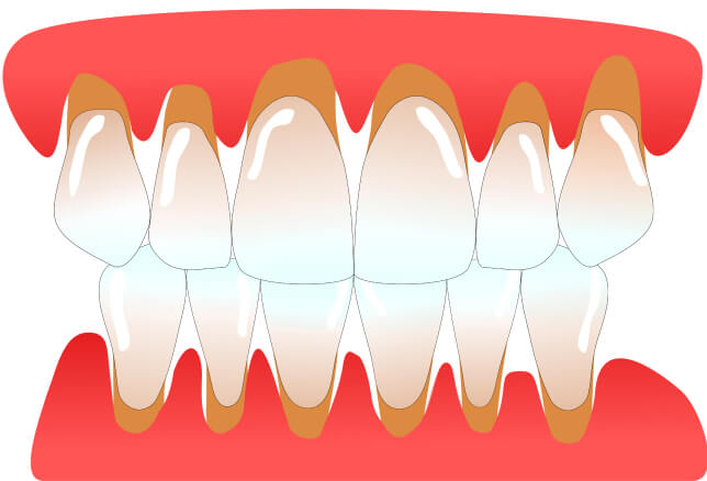 Zahnfleischbehandlung (Zahnfleischkorrektur) - Was ist Zahnfleischrückgang und wie entsteht er?