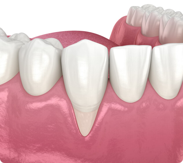 Zahnfleischtransplantation - Gibt es Alternativen zur Zahnfleischtransplantation?
