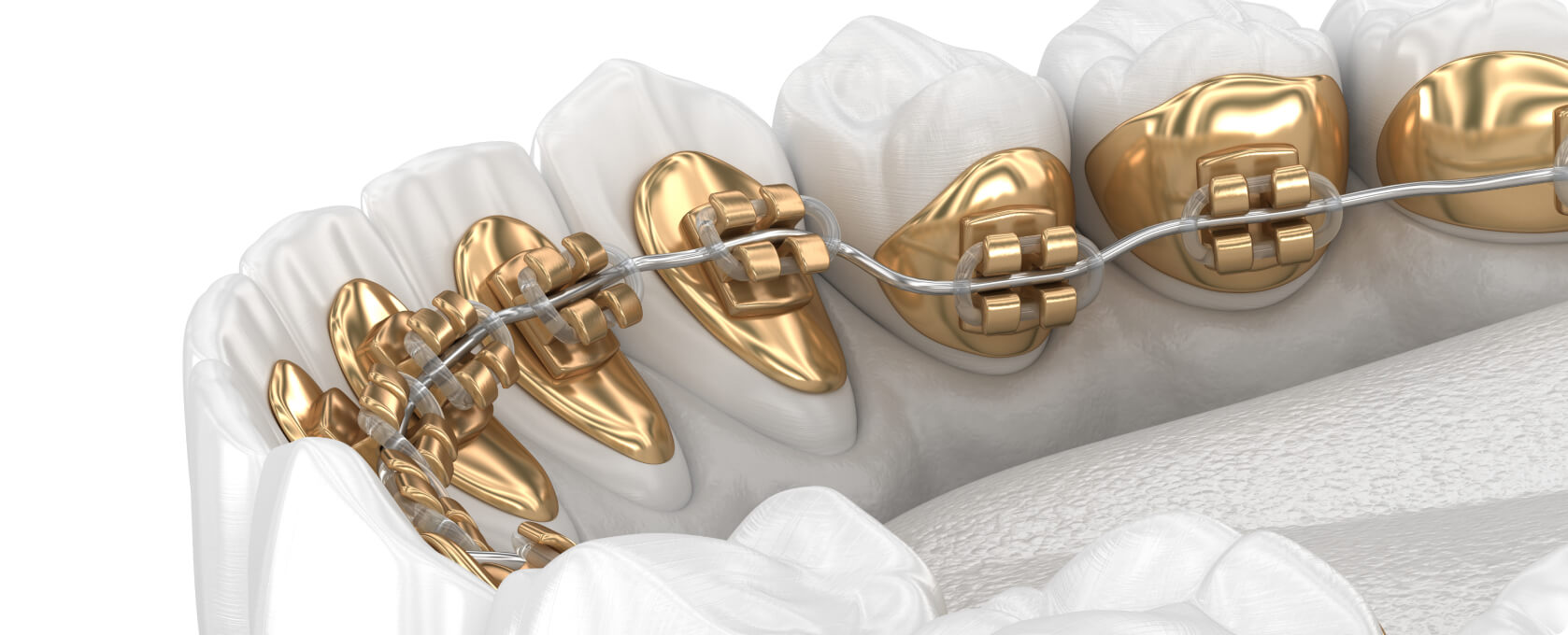 Zahnspange - Wie funktioniert die Behandlung mit einer Zahnspange von innen?