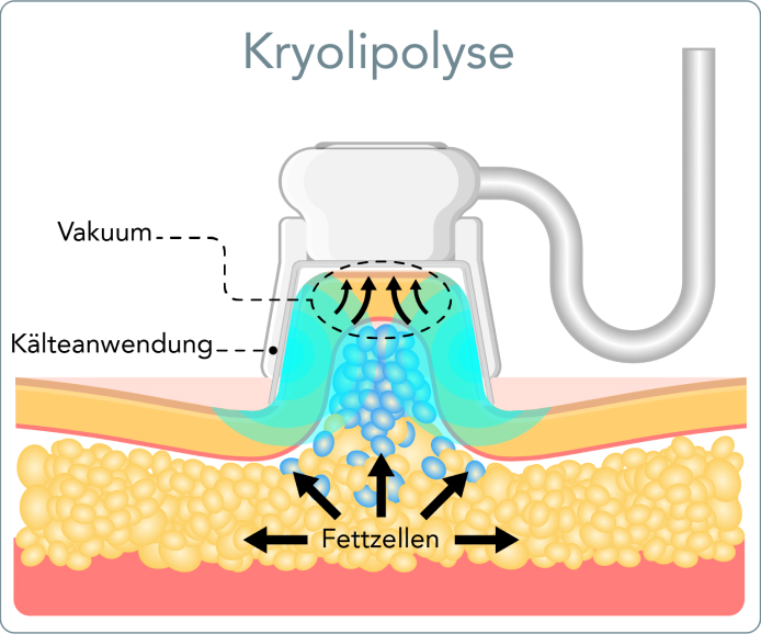 Kryolipolyse  - Wie funktioniert die Kryolipolyse?