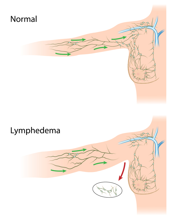 Lymphödem - Was sind die Ursachen des Lymphödems?