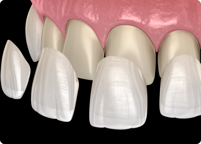 Bleaching (Zahnaufhellung) - Wie funktioniert die Zahnaufhellung mit Veneers?