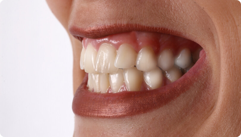 Bruxismus (Zähneknirschen) - Was sind die Symptome von Bruxismus?