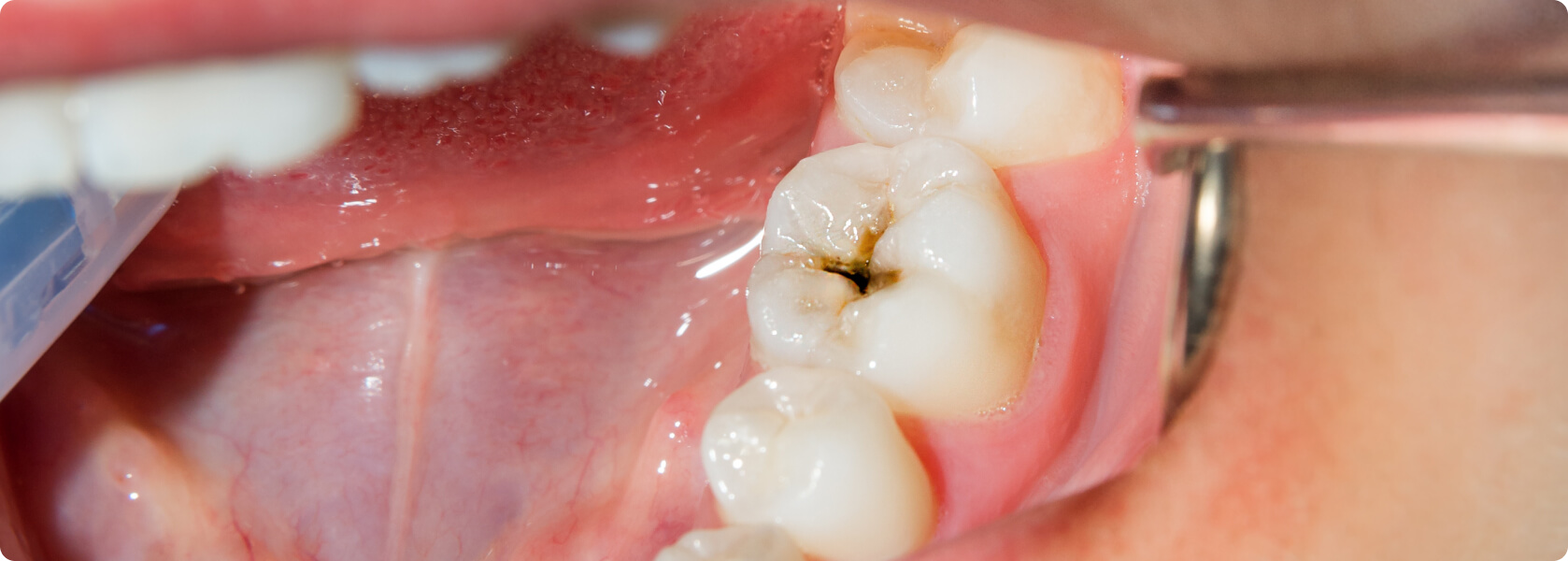 Wird schmerzt und zahn grau Zahnschmerzen nach