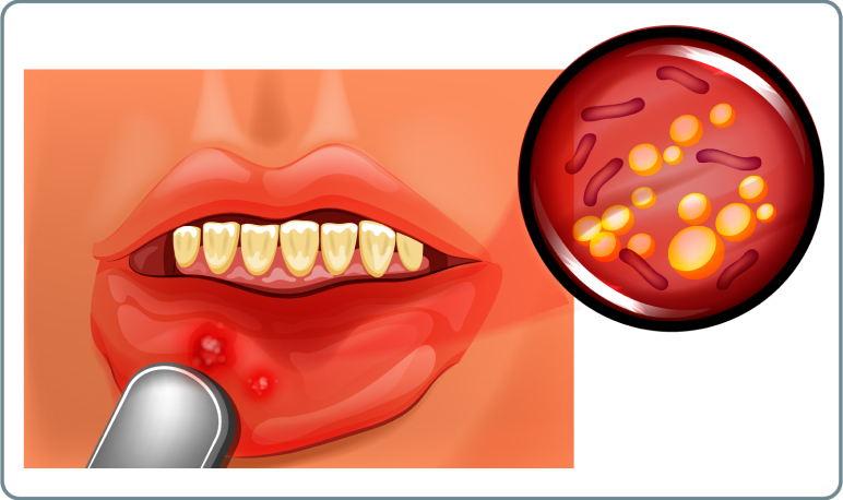 Mundfäule (Stomatitis) - Auch die Mundfäule äußert sich mit Bläschen und Aphthen ähnlichen Geschwüren an Gaumen