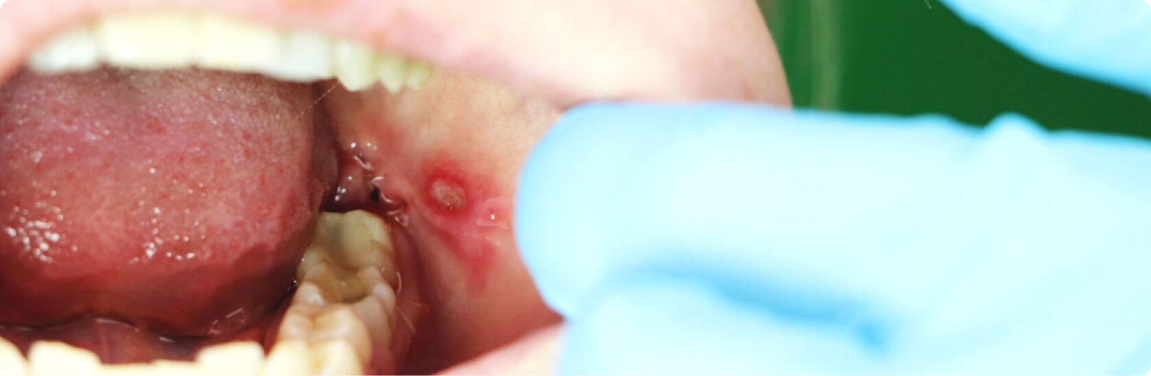 Mundfäule (Stomatitis) - Was ist eine Mundfäule?
