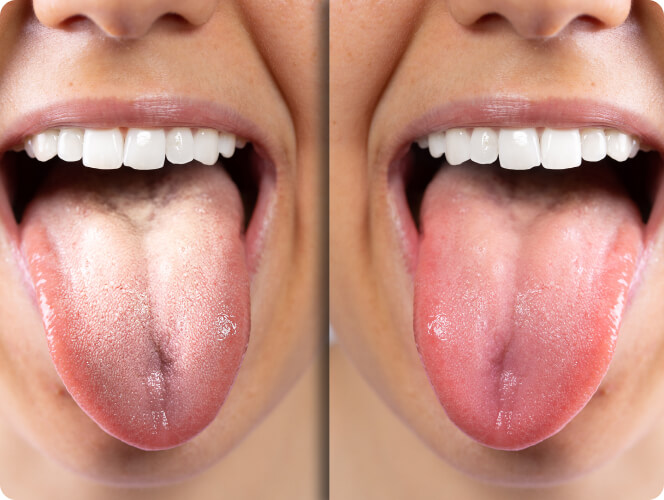 Mundgeruch (Halitosis) - Wie lässt sich Mundgeruch behandeln?