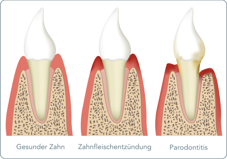 Parodontitis (Parodontose) - Welche Formen der Parodontitis gibt es?