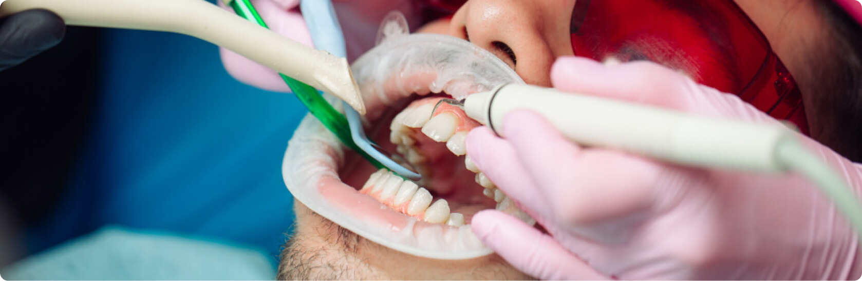 Professionelle Zahnreinigung - Habe ich bei einer professionellen Zahnreinigung Schmerzen?