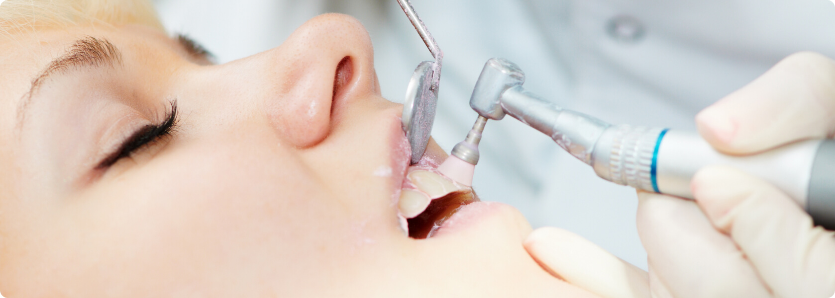 Professionelle Zahnreinigung - Was ist eine professionelle Zahnreinigung?