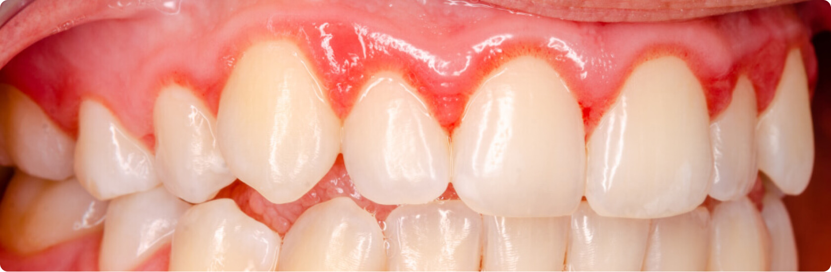 Zahnfleischentzündung (Gingivitis) - Was ist eine Zahnfleischentzündung?