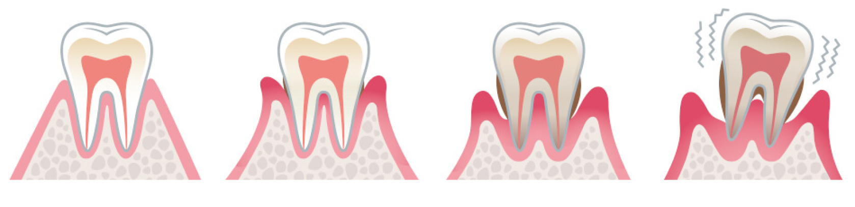 Zahnfleischrückgang (Zahnfleischschwund) - Was ist ein Zahnfleischrückgang?
