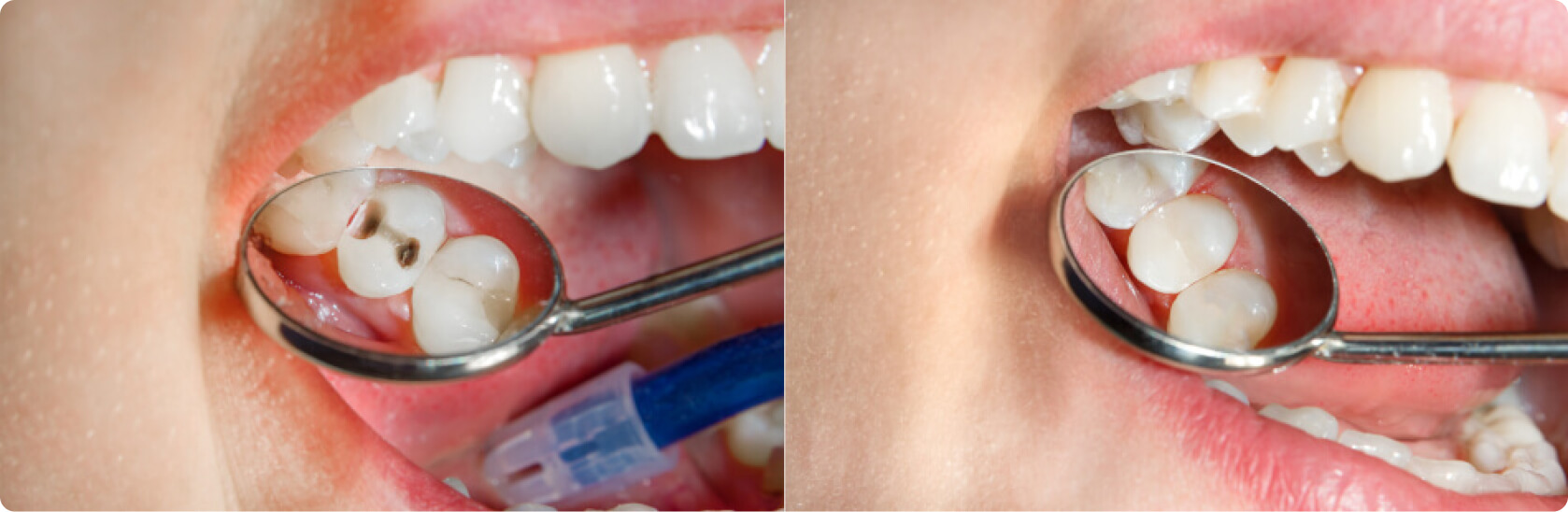 Zahnfüllung - Was ist eine Zahnfüllung?