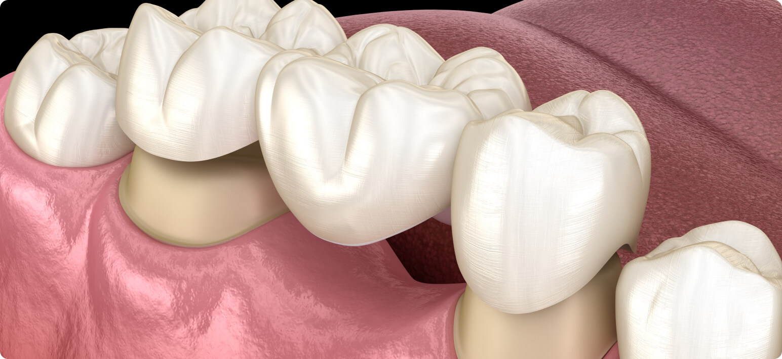 Zahnkrone - Verankerungskronen