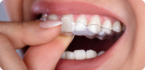 Zahnlücke (Diastema) - Aligner-Systems