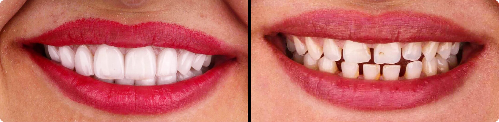 Zahnlücke (Diastema) - Wie lässt sich ein Diastema zwischen den Schneidezähnen schließen?
