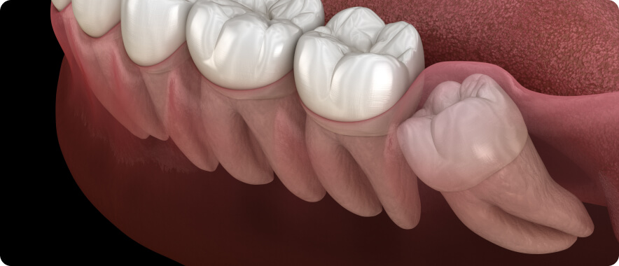 Zahnschmerzen - Weisheitszahn-OP
