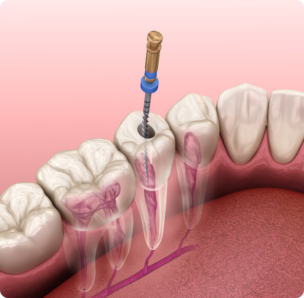 Zahnwurzelentzündung - Wann ist bei einer Zahnentzündung eine Wurzelspitzenresektion notwendig?
