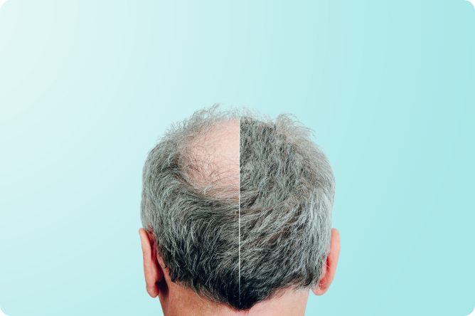 Haarausfall - Welche chirurgischen Verfahren zur Behandlung von Haarausfall gibt es?